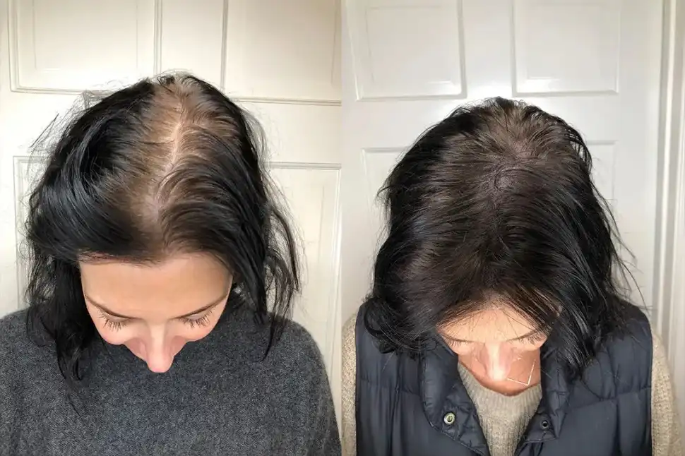 Scalp