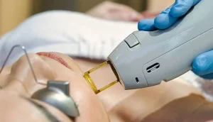 دستگاه لیزر مو کندلا جنتل مدل 2025